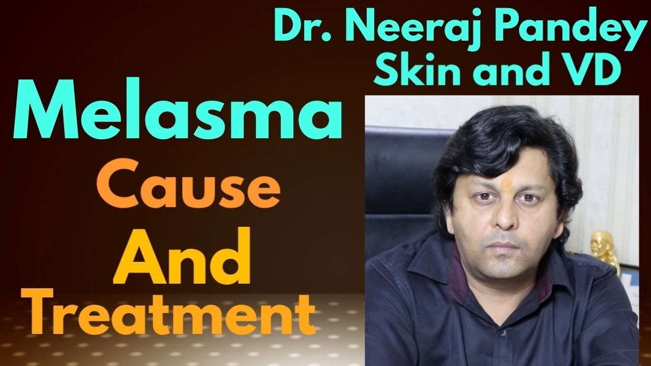 Melasma (Dark spots on face) - Its Cause and Treatment 