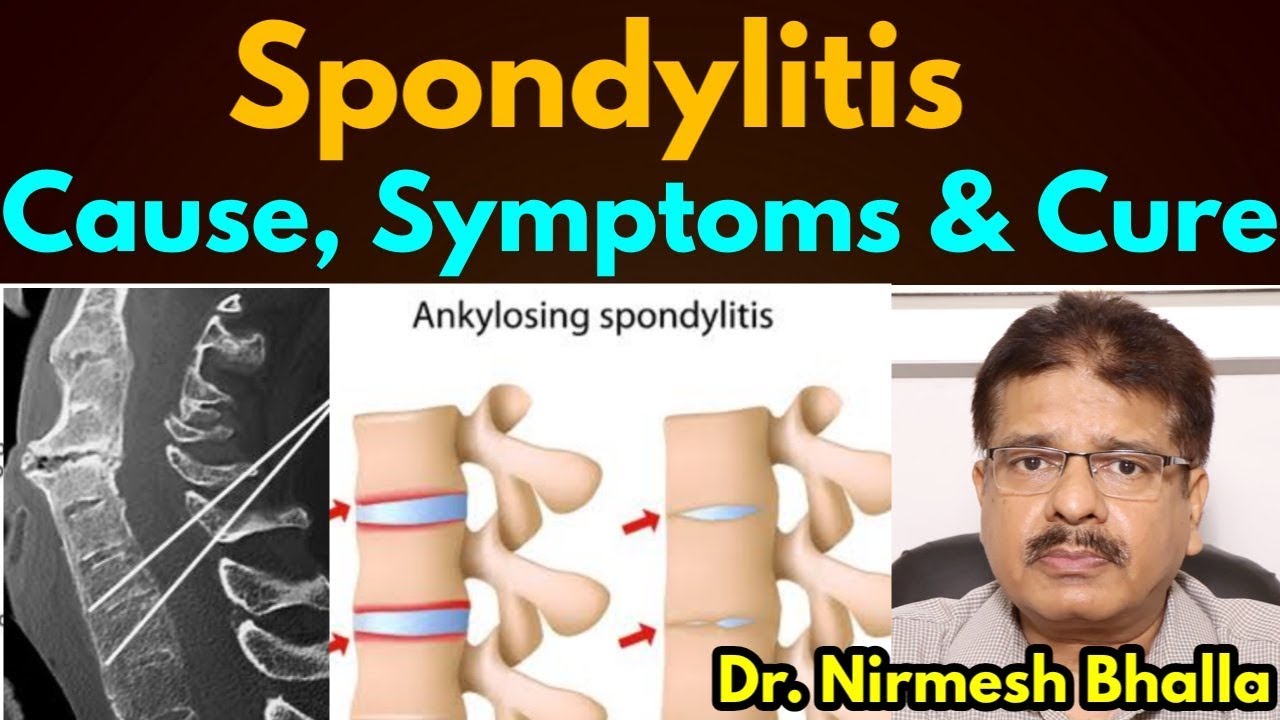 Spondylitis Its cause, symptoms and treatment